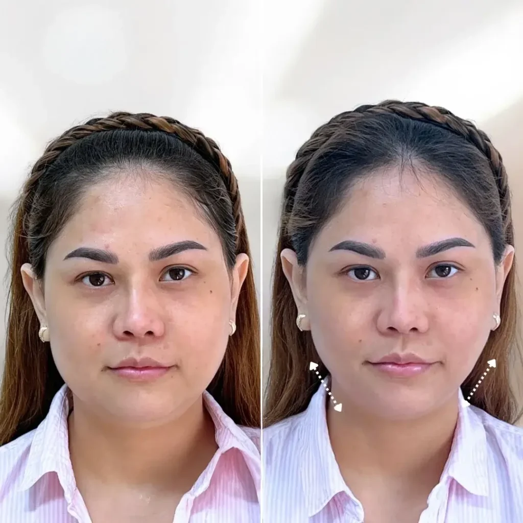 kasaderm hifu face lift (1)