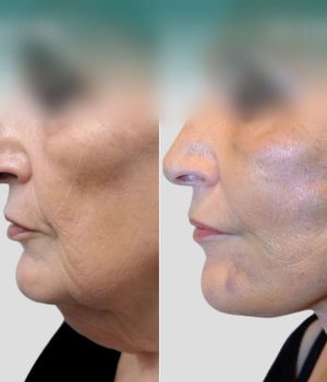 double-chin-removal-min